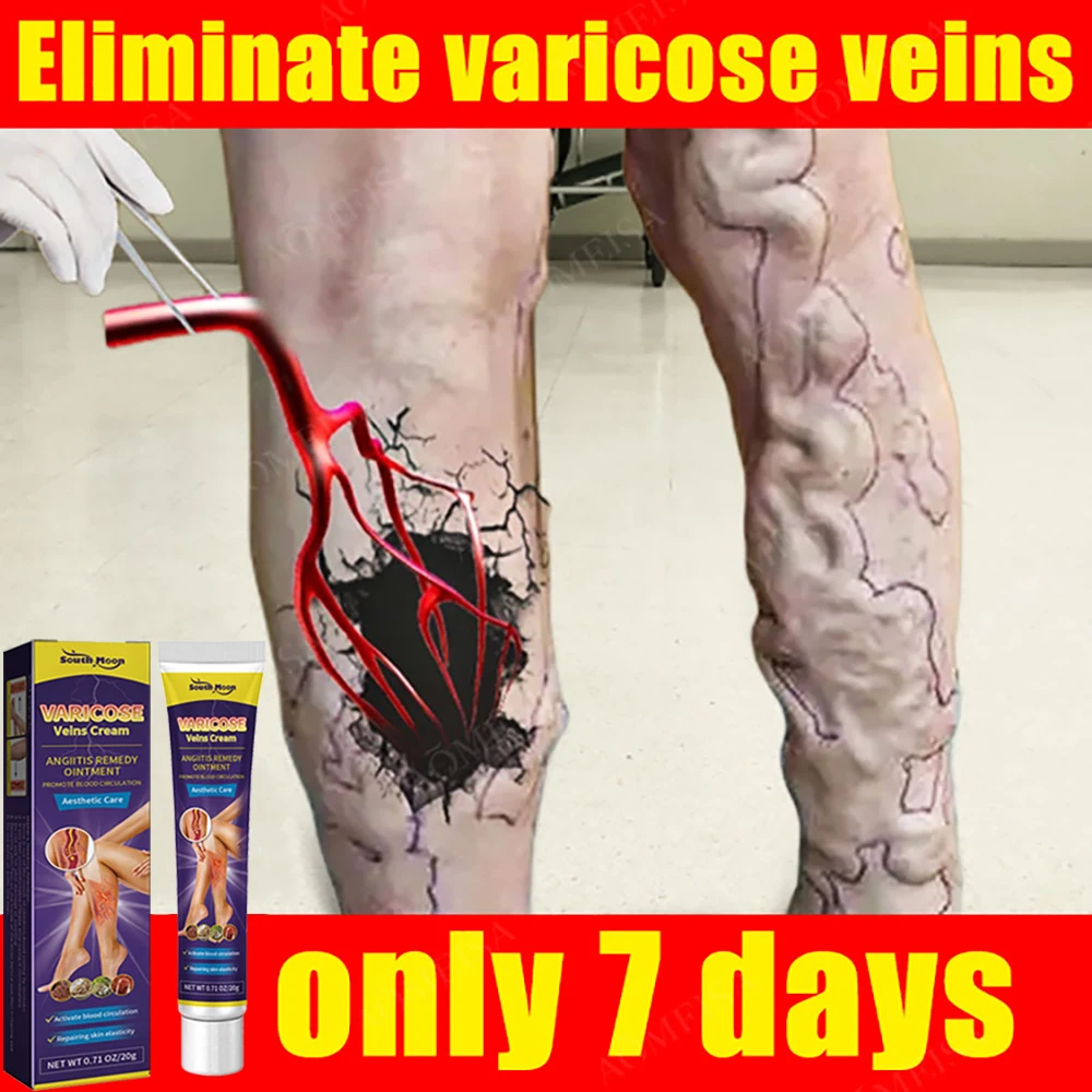 

Effective Varicose Veins Cream Relieve Vasculitis Phlebitis Spider Pain Relief Ointment Herb Plaster Beauty Body Care