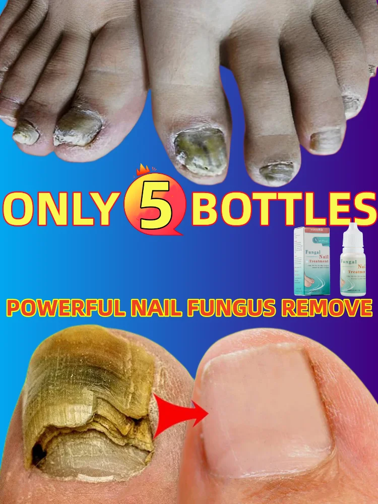 

Treat Nail Fungus Serum Repair Toe Fungal Essence Removal Hand Foot Onychomycosis Paronychia Gel Anti Infection Cream Product