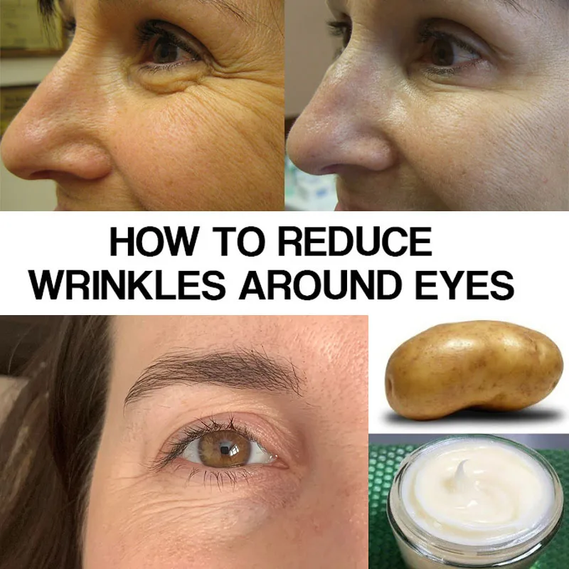 

Маски для лица против морщин, удаление пюре картофеля от морщин под глазами, витамин С, средство против старения, способствует производству ...