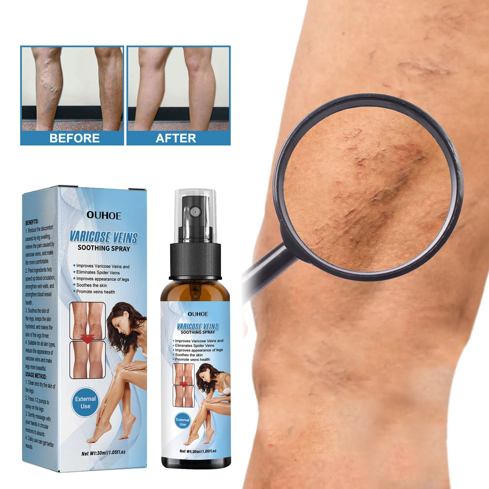 

Vasculitis Treatment Spray Varicose Vein Pain Relief Smoothing Redness Swelling Angiitis Treatment Phlebitis Spider Leg Liquid