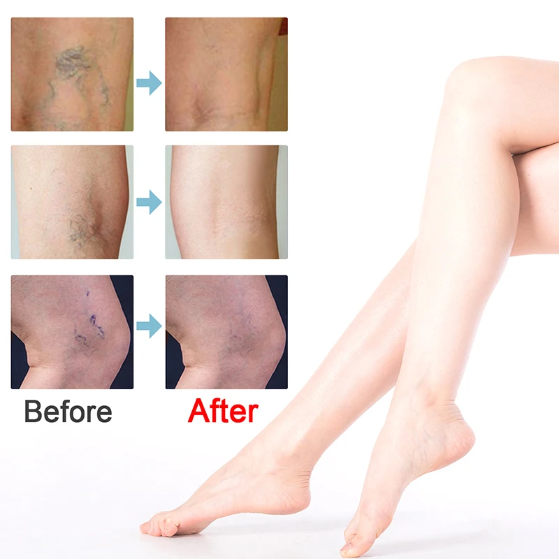 Крем для варикозного расширения вен 20 г |