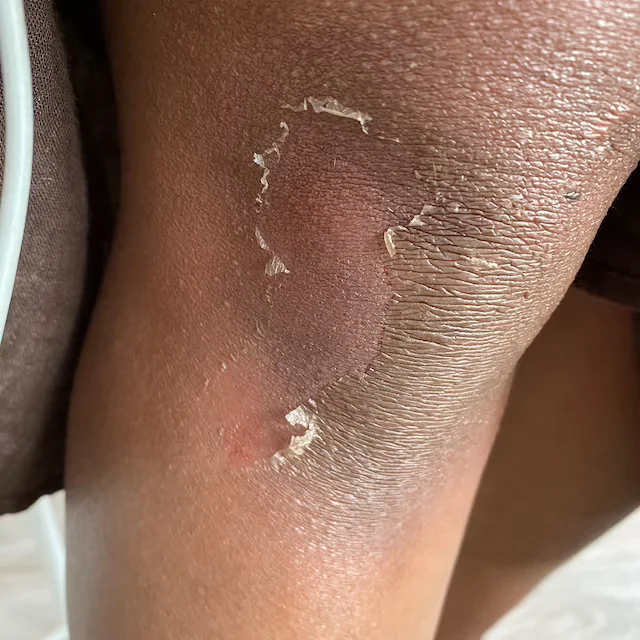 Желтая отшелушивающая масло для осветления темных пятен на коже, прыщей, пятен, противодействующее плохим прыщам, усиленное осветление.