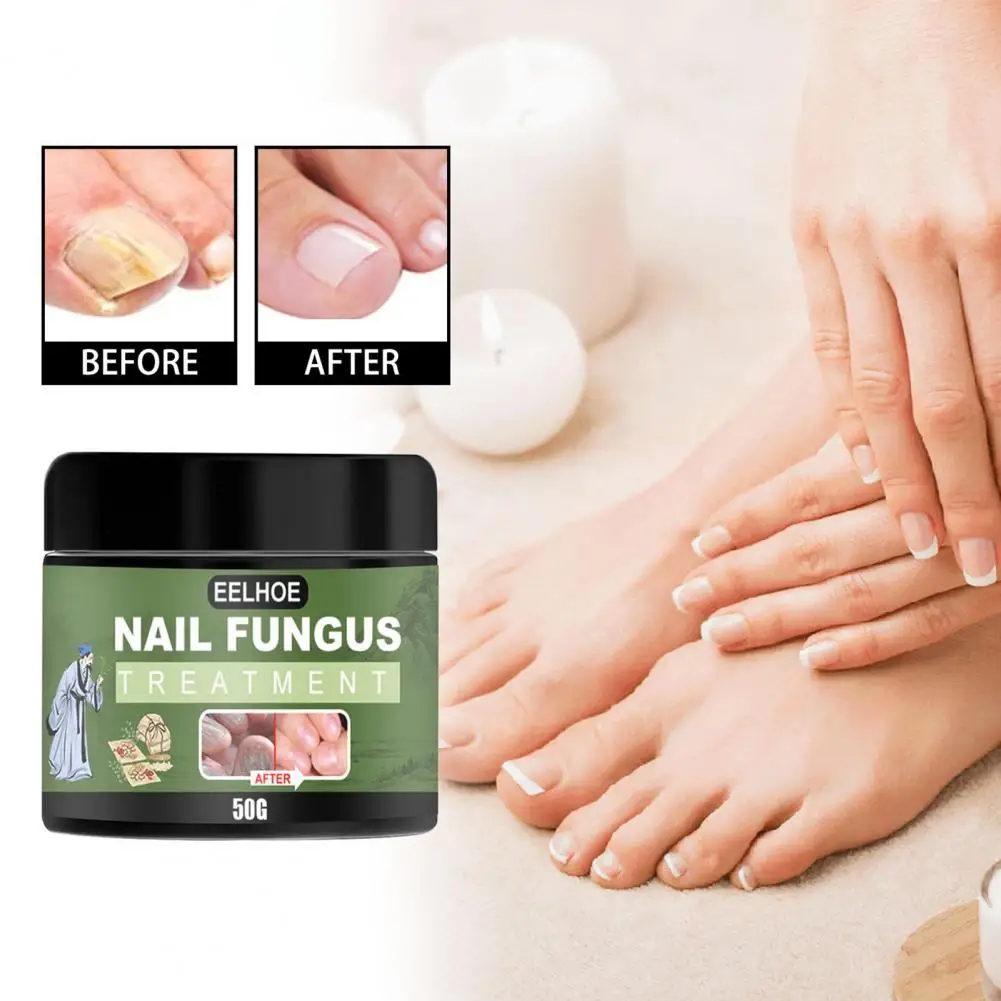 

10/30/50g Nail Fungus Cream Nail Fungus Repair Nourish Fast Healing No Harm Convenient Foot Care Portable Fungal Nail Treatment