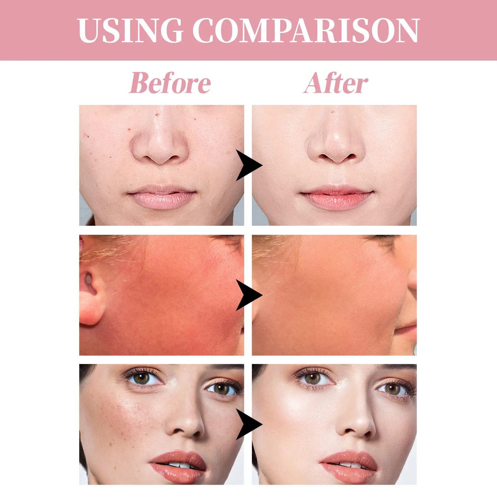 Рекомендуется увлажняющий и нежирный отбеливающий крем с защитой от УФ-лучей