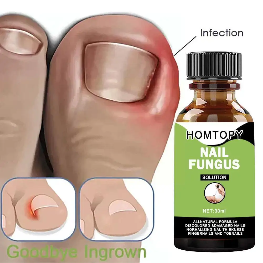 

Nail Fungal Treatment Feet Care Essence Anti Infection Onychomycosis Gel Fungus Foot Paronychia Medicine Removal Toe Chines F5E2