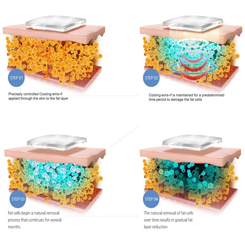 Профессиональная машина для замораживания жира потеря веса замораживание