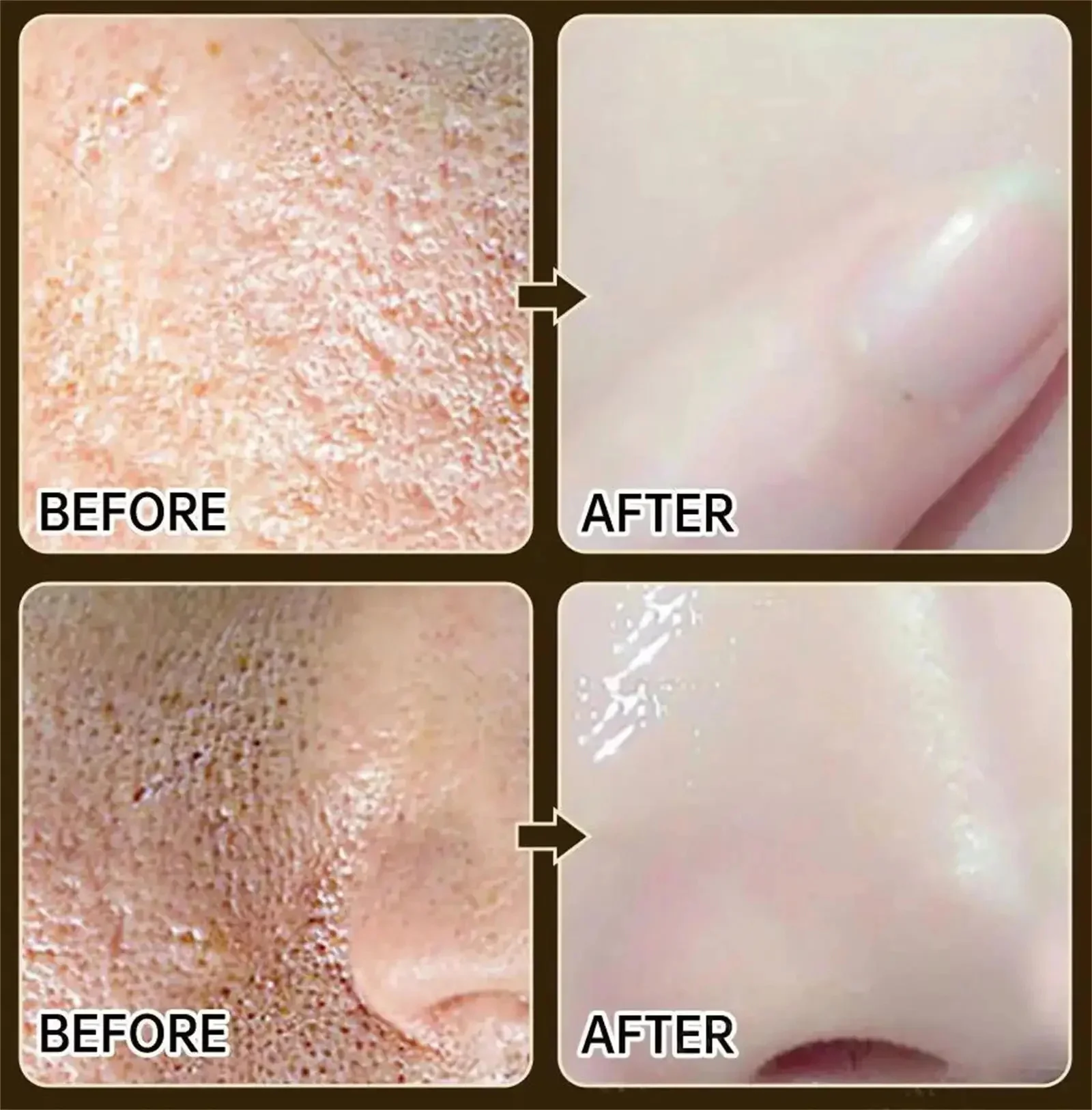 Сыворотка для сужения пор пилинг лица удаление больших подтяжка восстановление