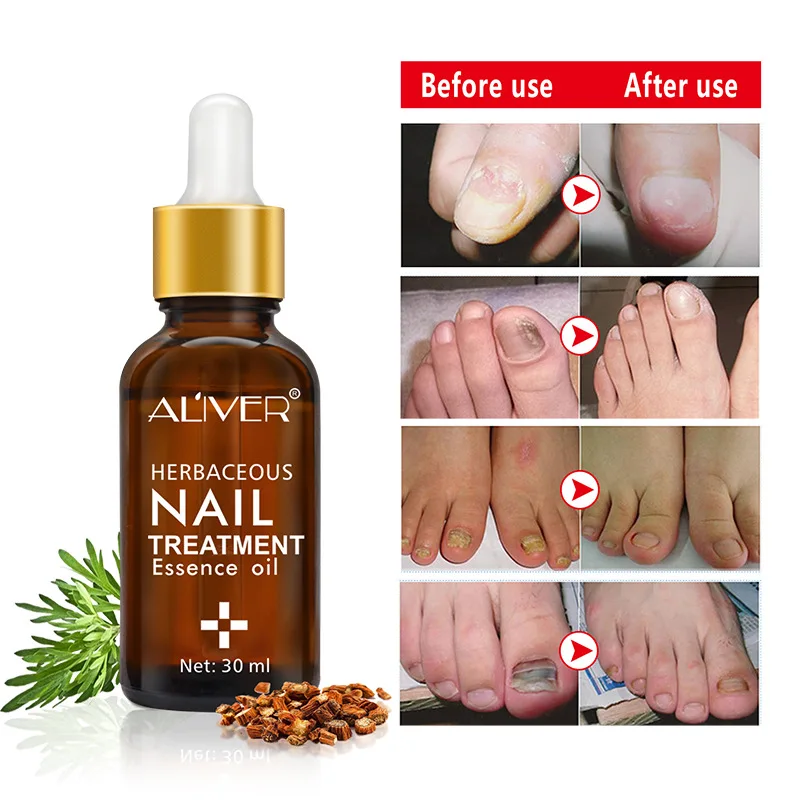 

Treatment Fungal Nail Essence Serum Care Repair Foot Nail Fungus Removal Gel Anti Infection Paronychia Onychomycosis Product