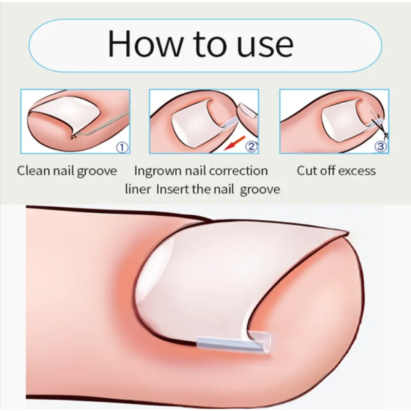 Рисунок 3 - Инструмент для коррекции вросших ногтей