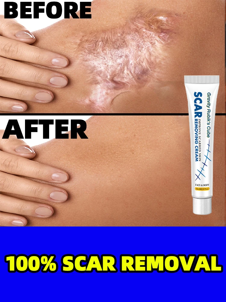 

Крем для удаления шрамов со старой кожей, глубокое навсегда отметьте гелевое лечение