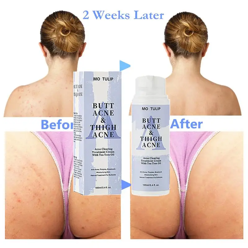 

100ml Acne Removal Cream Clearing Spot Treatment Clears Acne Pimples Zits Razor Bumps Dark Spot Buttocks Thigh Area Lotion