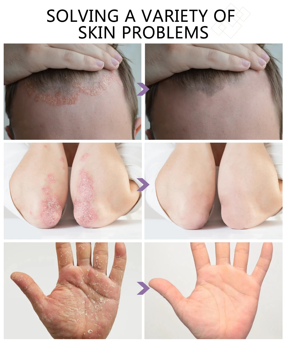 Тройная мазь от топового дерматита экземы травяная эффективный