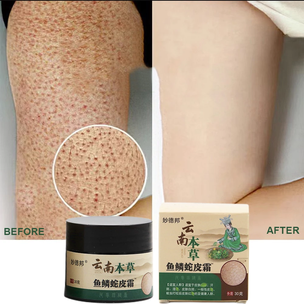 

Chicken Skin Repair Cream Curing Keratosis Follicle Pilaris Body Dark Spot Remove Thick Pores Moisturizing Smooth Essence Lotion