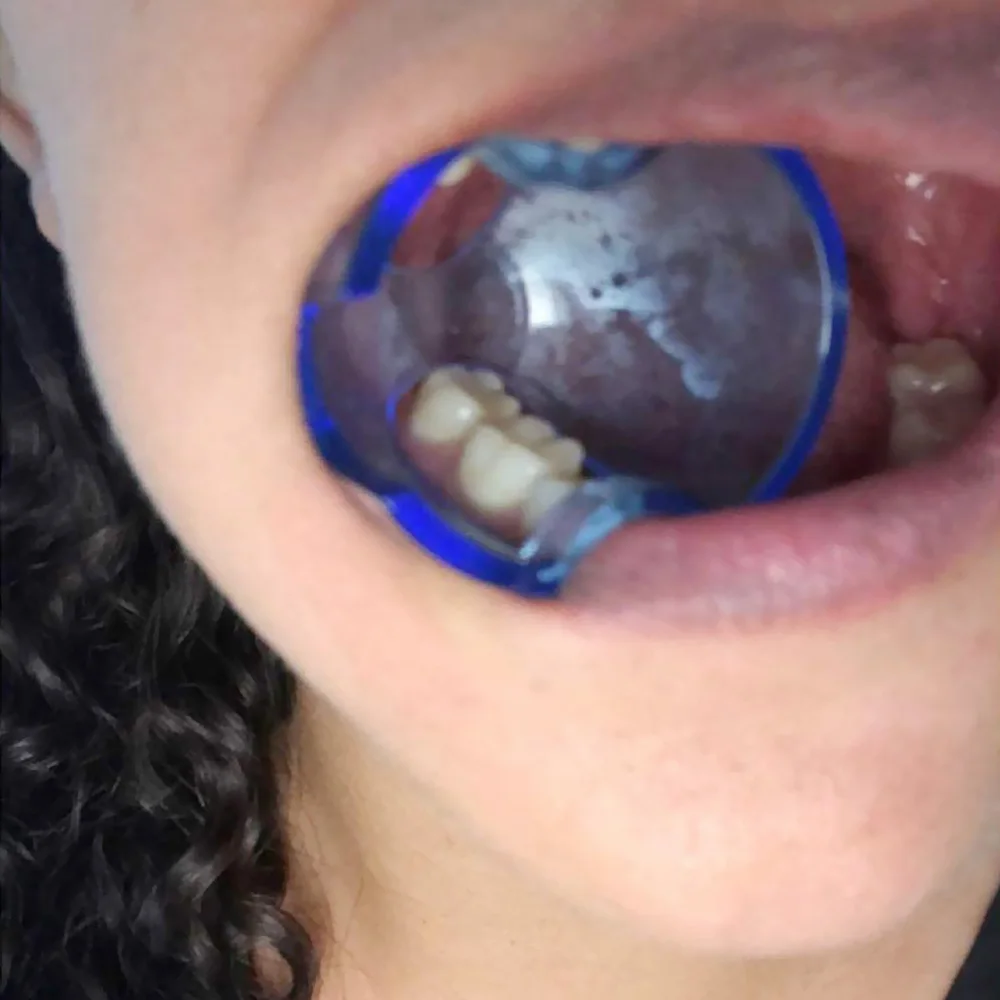 Стоматологический Ретрактор для щеки Передние Задние зубы отбеливания рта