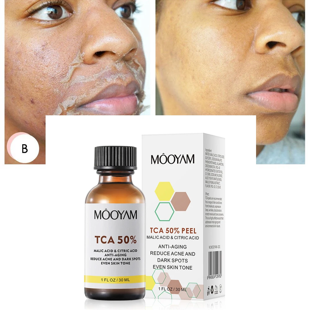 

50% TCA Chemical Peel Acid Skin Superforce Peel Pigmentation Lightening Melanin Acne Treatment Remove Scar 30ML