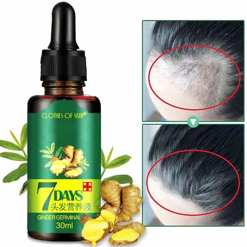 

7Day Ginger Germinal сывороточная эсенция Лечение выпадения масла для роста волос против выпадения волос Alopecia восстановление поврежденных и жидких волос