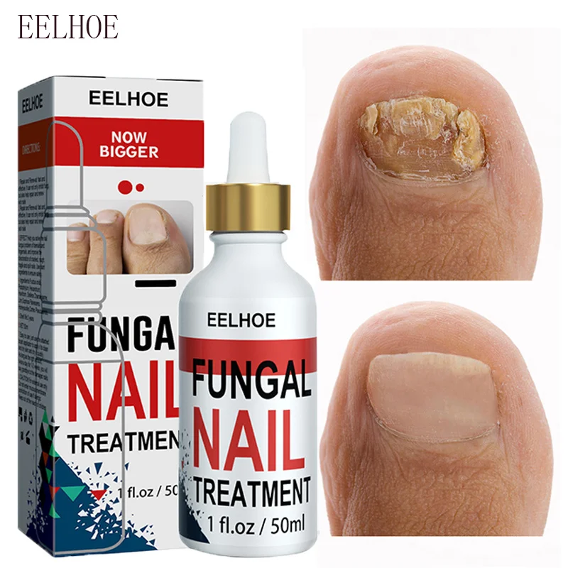 

Nail Fungal Treatment Serum Onychomycosis Paronychia Anti Infection Toe Nail Fungus Repair Gel Nourishing Health Hand Foot Care