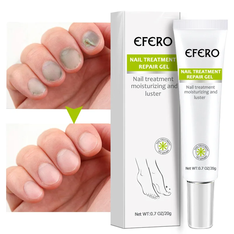 

Exfoliation, nail repair night Efero Nail Cream Treatment Repair Gel Moisturizing and Luster free shipping detox foot spa