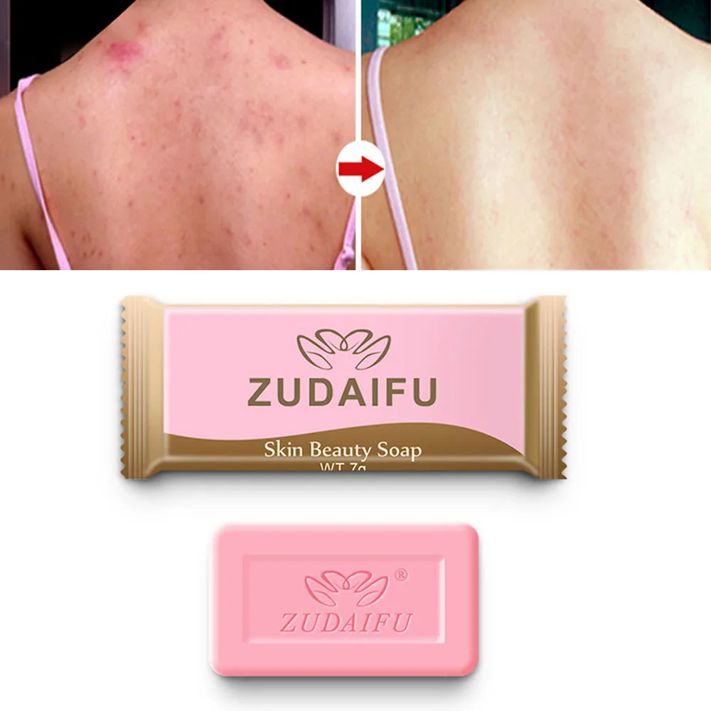 Серное мыло для очистки кожи от акне, псориаза Seborrhea Eczema, антигрибное банное мыло против клещей 7 г