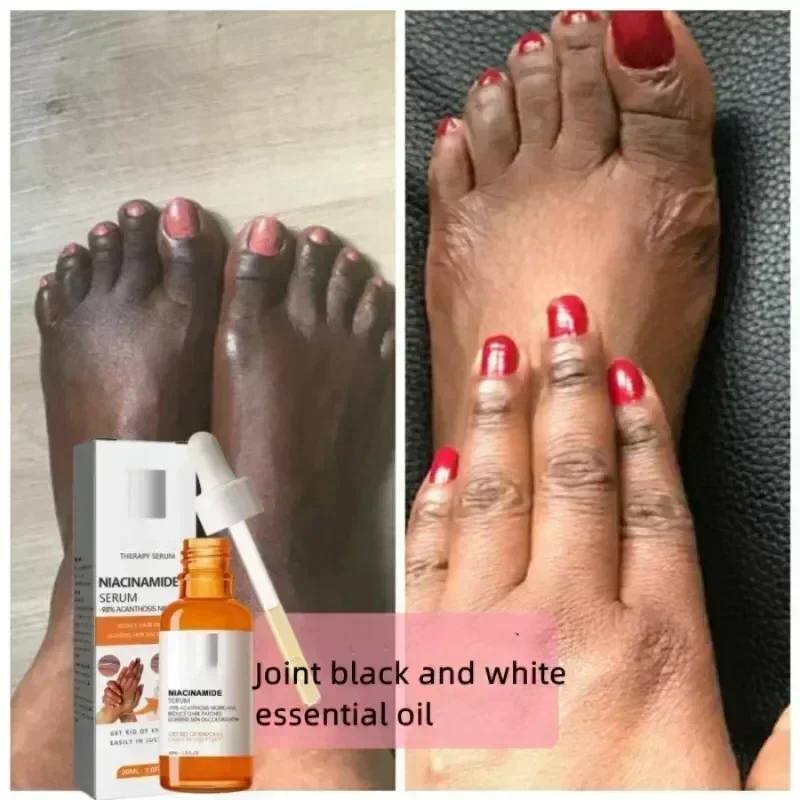 Dark knuckles whitening serum Elbows Armpit Beaching SerumWoman Private Part Skin Removal Knuckles Strong Whitenin HOT SAL
