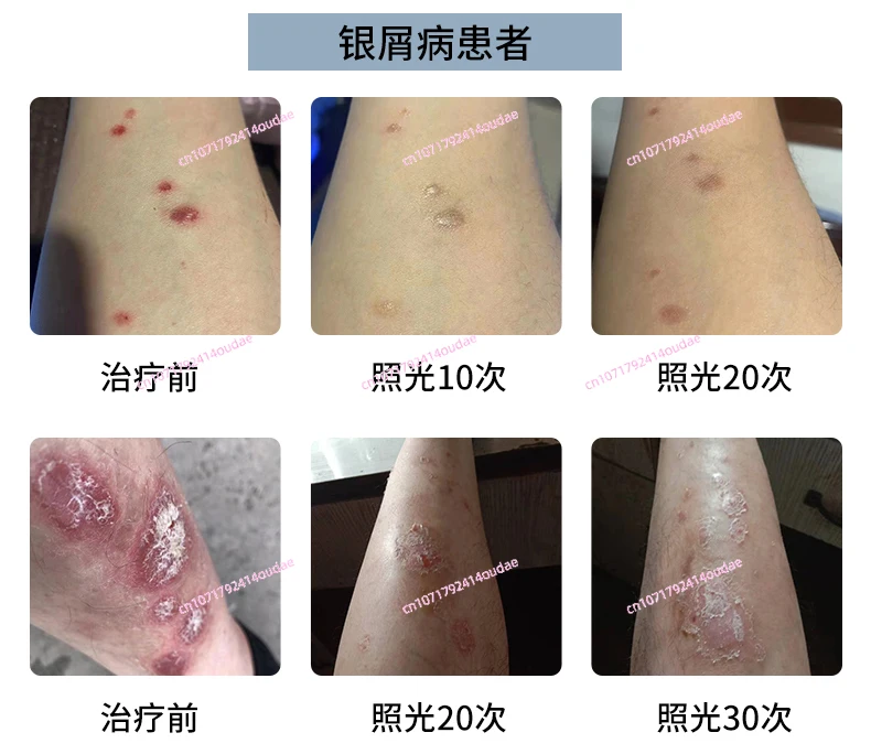 Медицинское устройство для фототерапии vitiligo домашнее лазерной терапии с