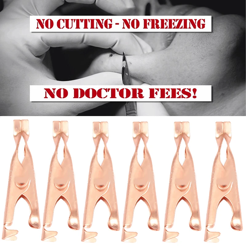 

Skin Tags Remover Clip For Wart Permanent Removal Painless Clip Tags Out Skin