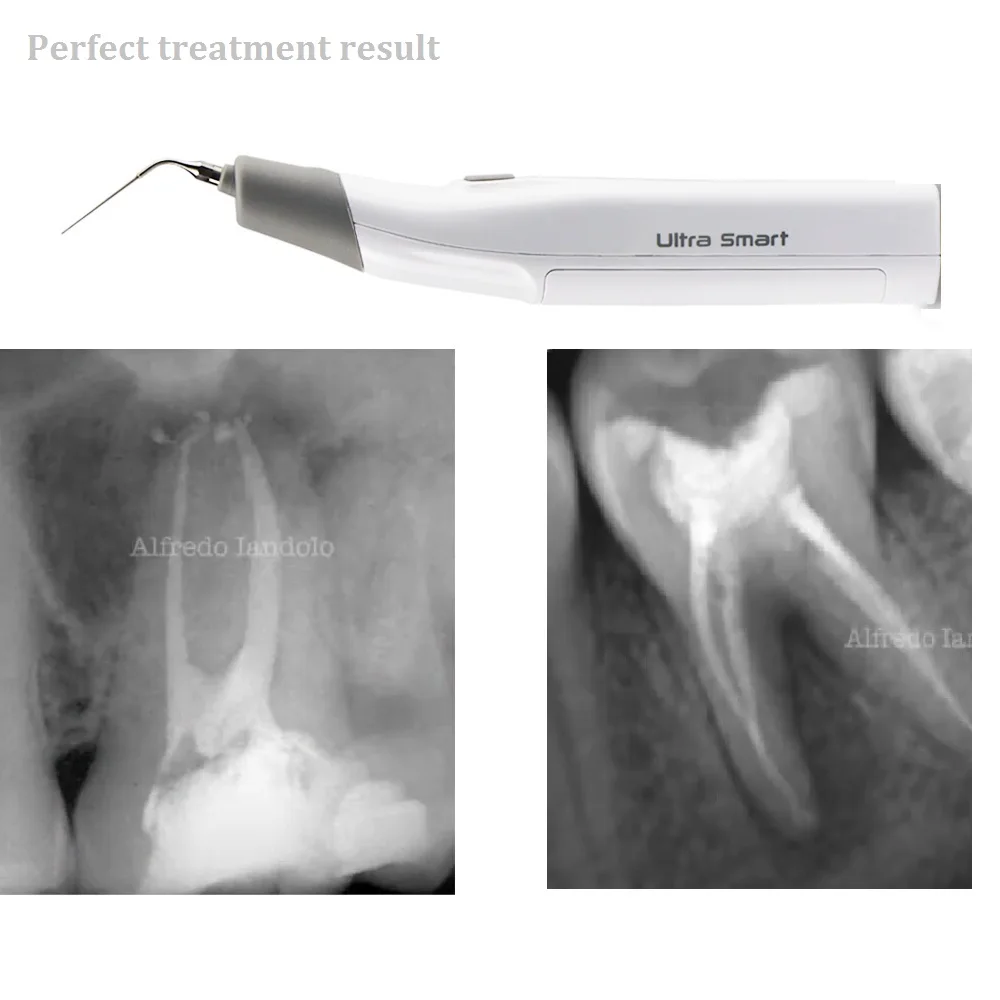 COXO Ultra Smart Endo Ultrasonic Activator Dental Root Canal Treatment Endodontic Tools Medical Devices