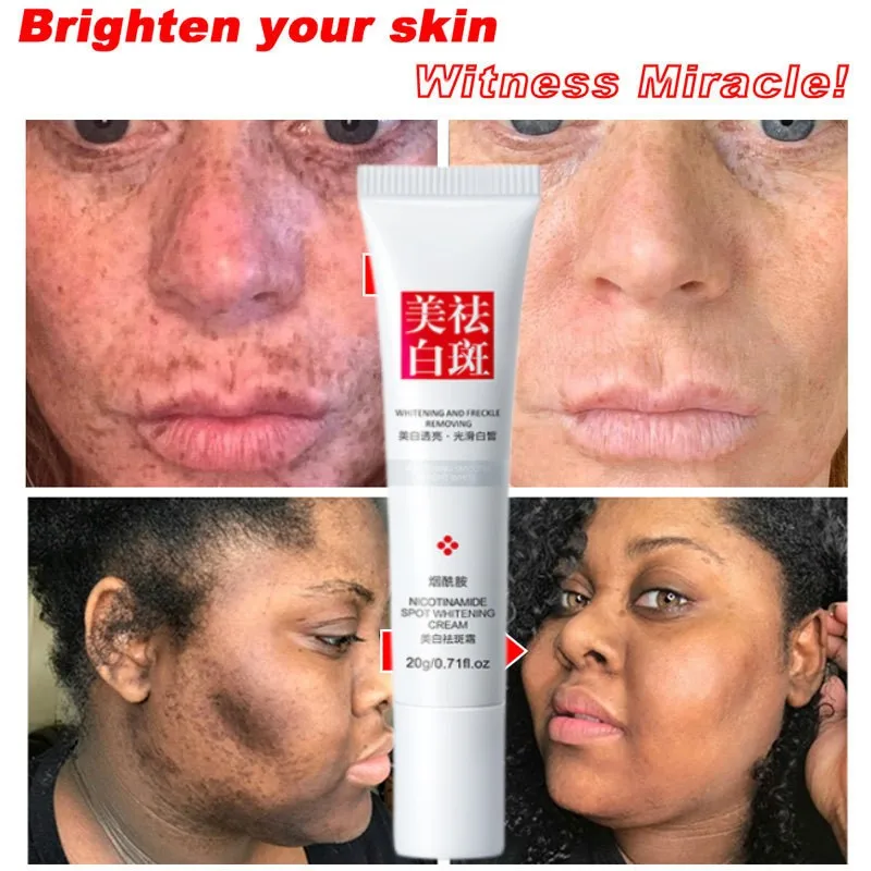 

Whitening Dark Spot Corrector Cream Freckle Blemish Removal Serum Lighten Bright Skin Reduces Age Spots Acne Improve Dullness