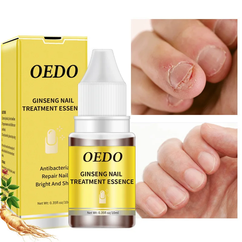 

10ml Fungal Nail Repair Essence Herbal Anti Fungus Treatment Onychomycosi Paronychia Anti-Fungal Anti-Infective Toe Nails Care