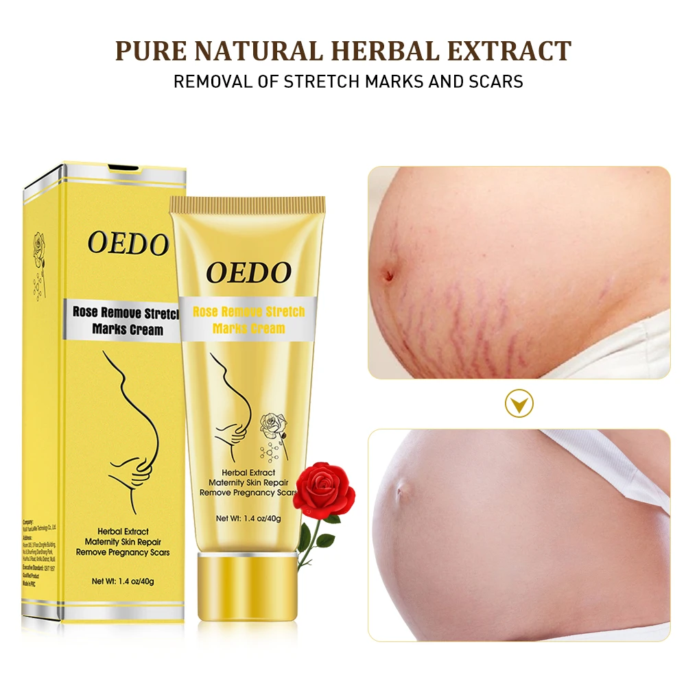 

Maternity Stretch Marks Removal Cream Body Buttock Breast Mark Skin Care Effective Anti White Stretch Scar Remover Body Cream