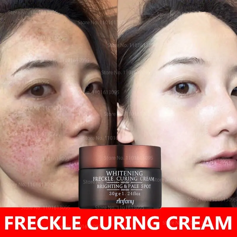 

Whitening Freckles Cream Melasma Dark Spot Lighten MolesDecomposition Melanin Brighten Skin Moisturizing Facial Treatment 30g