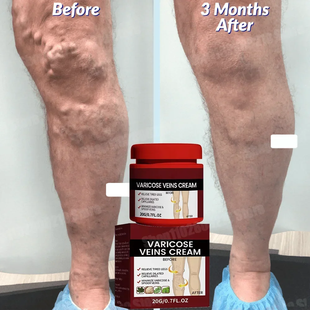 Натуральный крем для тела Крем ухода за кожей Уход дерматит Псориаз Экзема Кожа