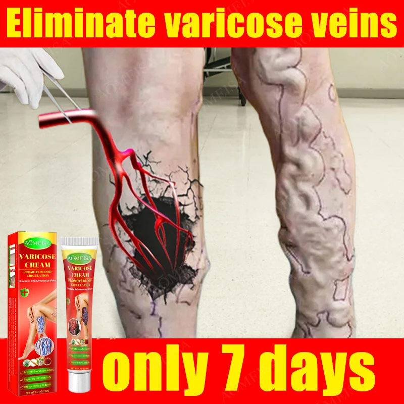 

Effective Varicose Vein Relief Cream Ointment For Varicose Veins To Relieve Vasculitis Phlebitis Spider Pain Treatment