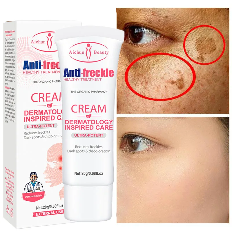 Freckles Removal Cream Nicotinamide Dark Spot Melanin Chloasma Blemish Remover Cream Melasma Treatment Whiten Brighte Face Care