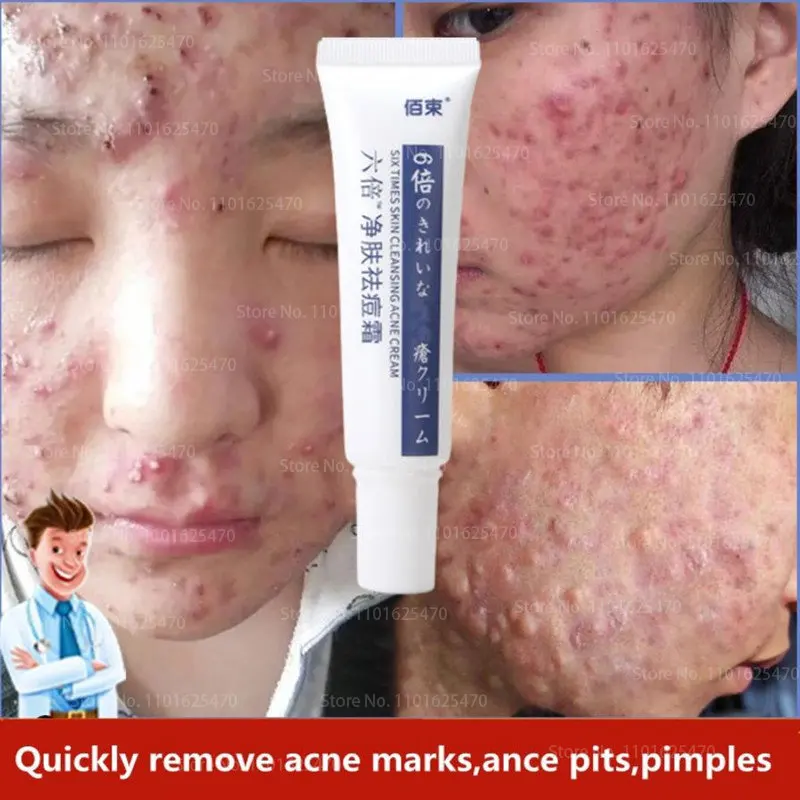 

Quick Acne Cream Acne Cream Acne Skin Care Products Get Rid of Acne Troubles and Restore Perfect Facial Skin Skin Whitening