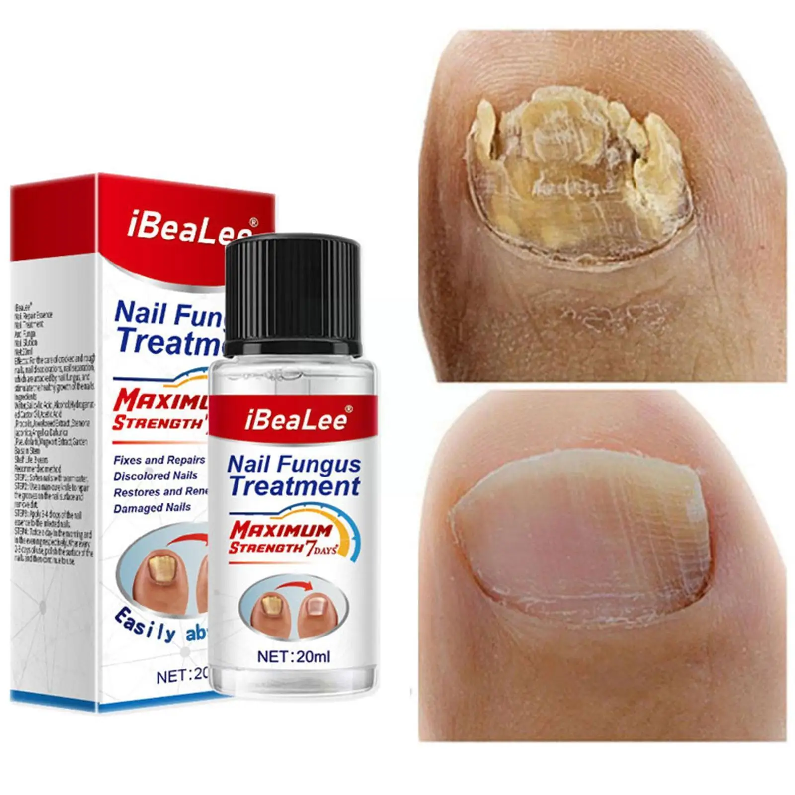 

20ML Nail Fungus Treatment Essence Serum Care Oil Hand fungal and Foot Nails Removal Repair Gel Care Anti-infective J9E4