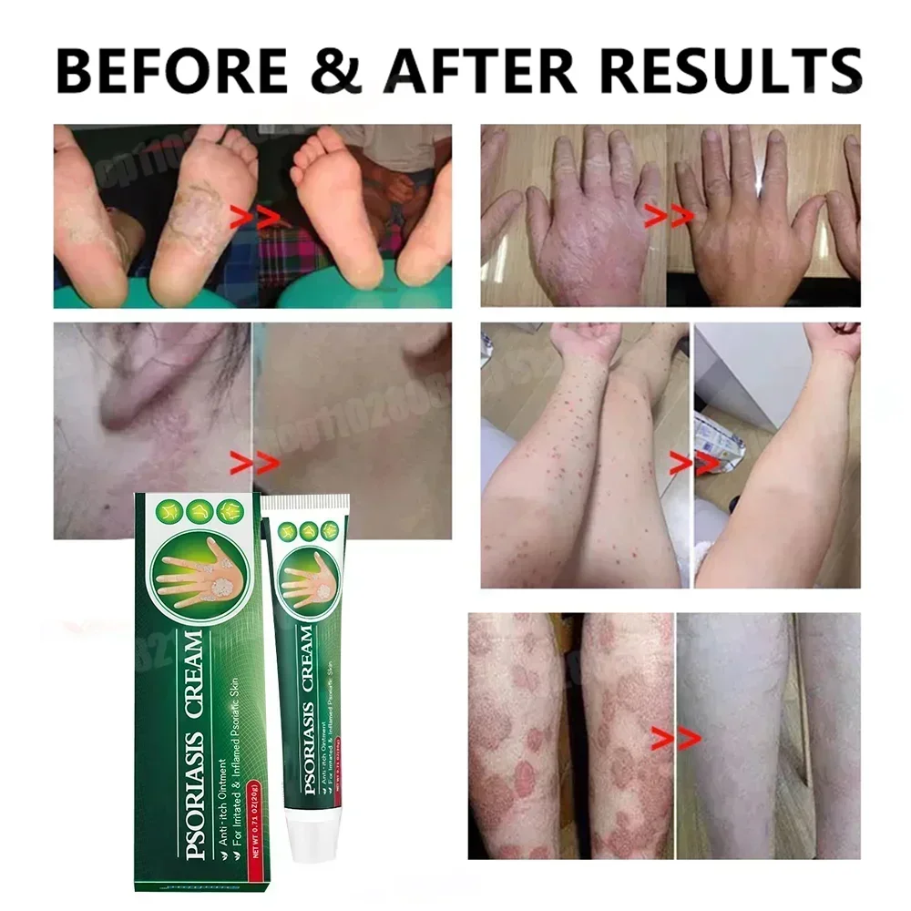 Antibacterial Cream Psoriasis Anti-itch Relief Eczema Skin Rash Urticaria Desquamation Healing