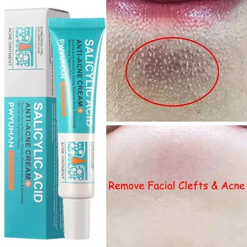 Крем для сужения пор с салициловой кислотой быстрое устранение больших удаление