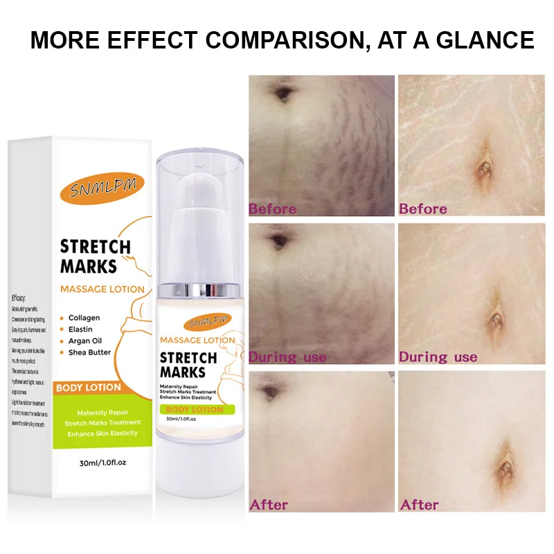 

Body Creams Remove Pregnancy Scars Acne Cream Stretch Marks Treatment Maternity Repair Anti-Aging Anti-Winkles Firming Skin Care
