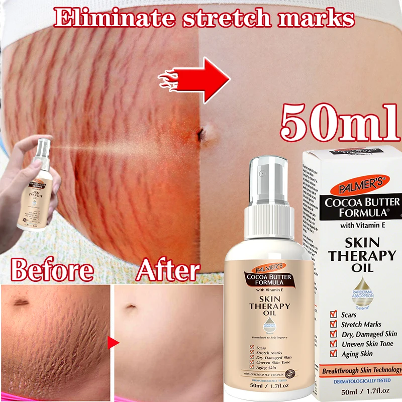 

Stretch Marks Remover Essential Oil Skin Care Treatment Cream For Stretch Mark Removal Maternity Slackline For Pregnant Oils