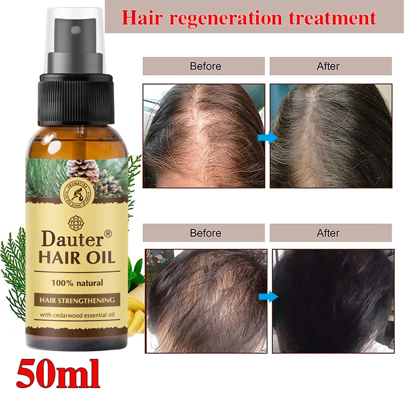 

Anti alopecia spray anti alopecia treatment rapid growth nourishment dry injury hair care prevention scalp injury men and women