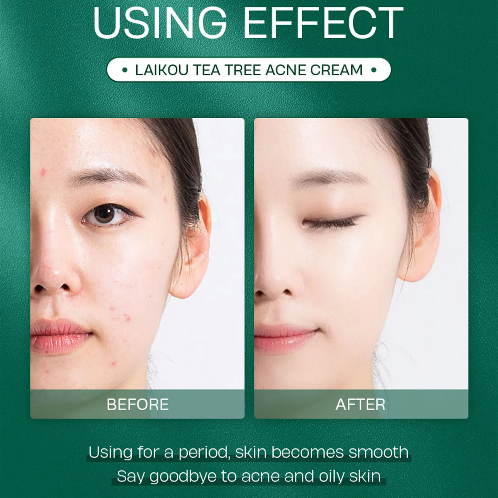 Крем LAIKOU увлажняющий отбеливающий для лечения акне и сужения пор