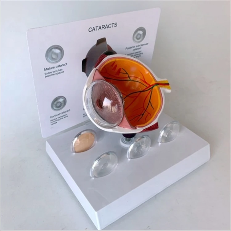 

Factory Cornea Eye Conditions Medical Anatomical Human Corneal Disease Model