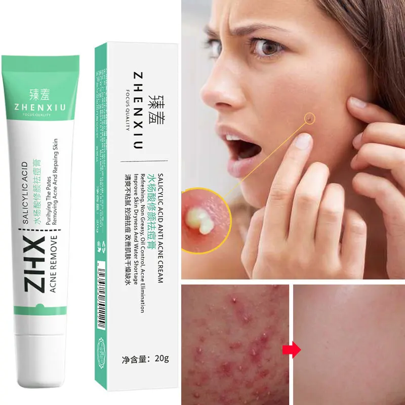 

Эффективный крем для удаления акне, Восстанавливающий увлажняющий гель для лечения акне и темных пятен