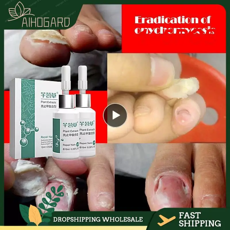 

1~5PCS Nail Liquid Antifungal Nail Bright Toe Finger Fungus Antibacterial Nail Liquid TSLM1