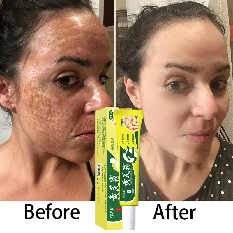 

Chinese Astragalus Whitening Freckles Cream Remove Melasma Fade Dark Spots Dark Yellow Skin Brighten Anti-aging Face Skin Care