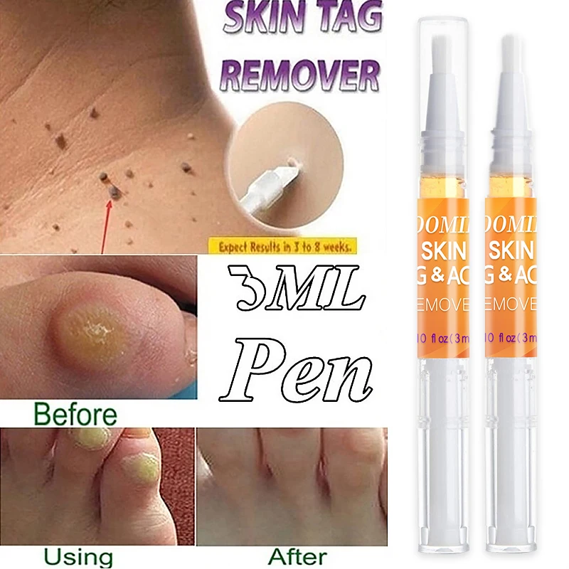 Флуоресцентная ручка для удаления бородавок с кожей жидкая лечения папилломы 1