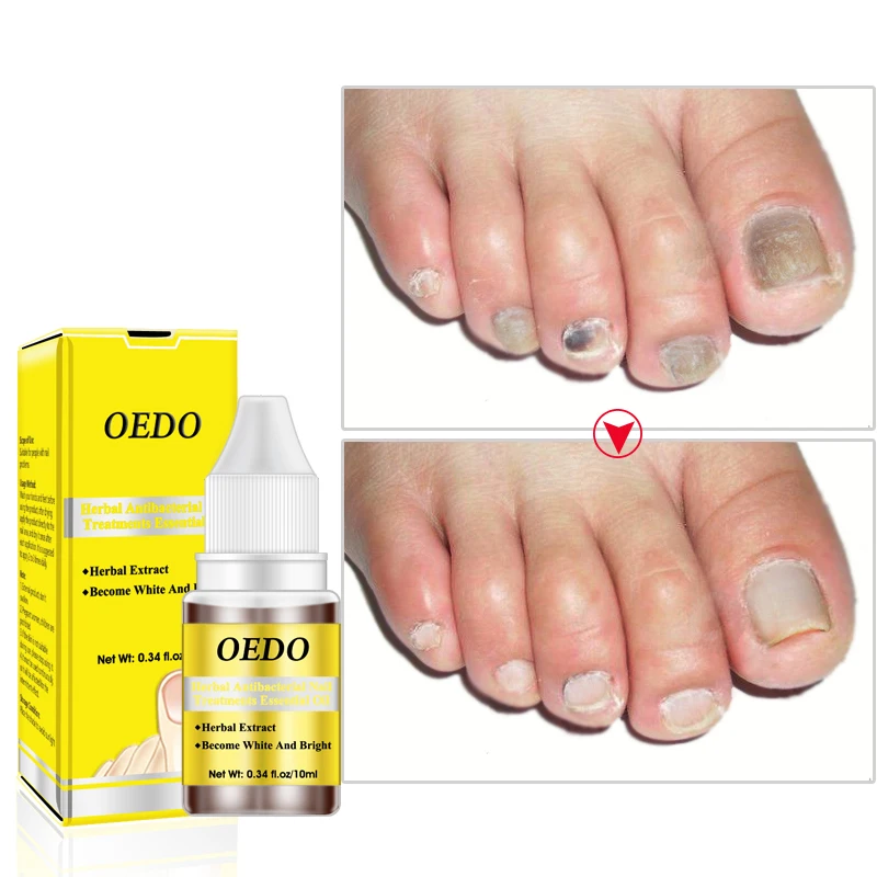 

Effective Natural Oil Nail Liquid Repair Treatment Nail Toe Fungus Removal Moisturizing Nail Foot Care 10ML