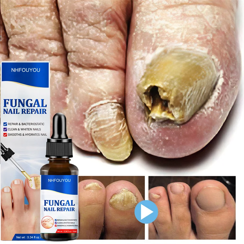 

Средство для лечения Ногтей от грибков, эссенция для восстановления ног, гель для удаления грибка на ногтях, противоинфекционный крем для удаления ногтей от грибка 10 мл