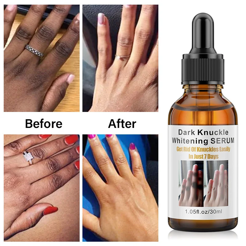 Dark Knuckles Fast Whitening Serum Pigmentation Correctors for Black Skin Hand Knuckle Elbows Knee Intense Stains Remover Serum